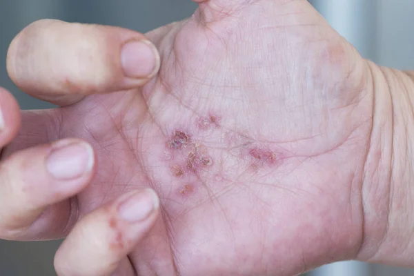 Dermatitis in hands — Stock Photo, Image