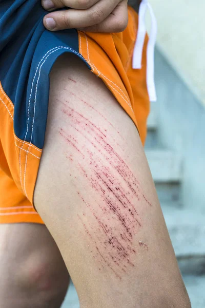 Herida en la pierna del niño . —  Fotos de Stock