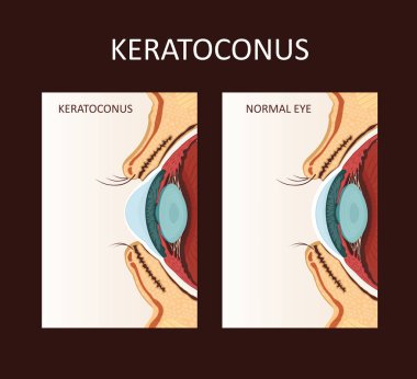 Keratoconus. Dystrophic disease of the cornea. clipart