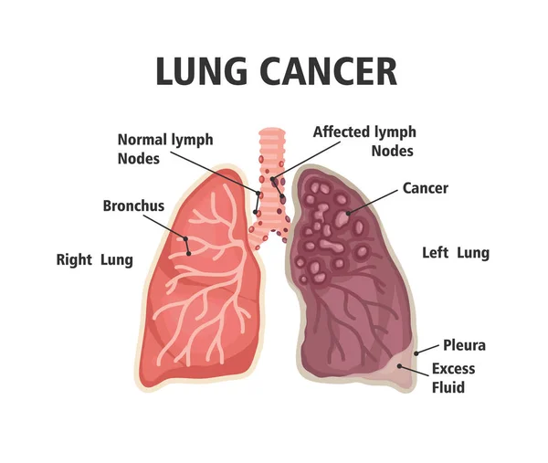 Comparação entre pulmão saudável e pulmão cancerígeno —  Vetores de Stock