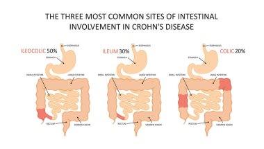Three most common sites of intestinal involvement in crohns disease clipart