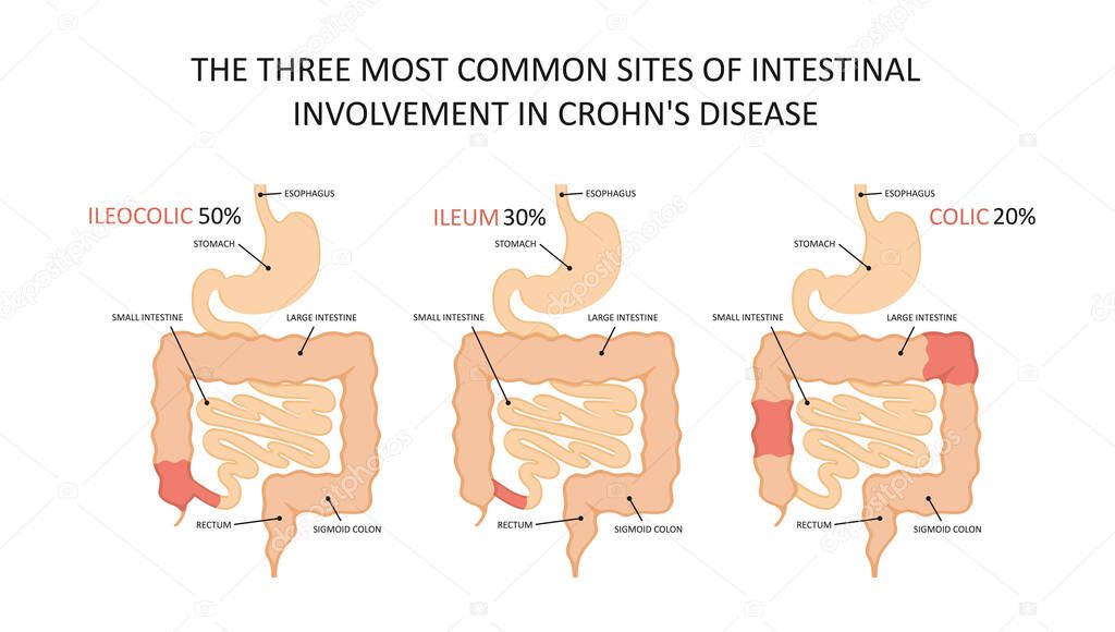 Three most common sites of intestinal involvement in crohns disease