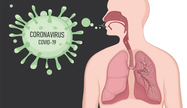 Ludzkie objawy koronawirusu, gruźlicy, zapalenia płuc, przeziębienia. Osoba zarażona koronawirusem. Epidemia wirusa Covid-19 rozprzestrzeniła się. — Wektor stockowy