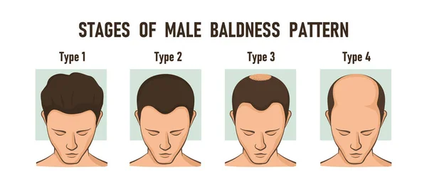 Stages of male baldness pattern. Male hair loss — Stock Vector