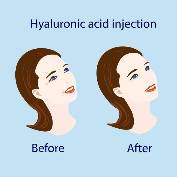 Hyaluronzuur injectie, vóór en beïnvloeden, vector illustratie — Stockvector