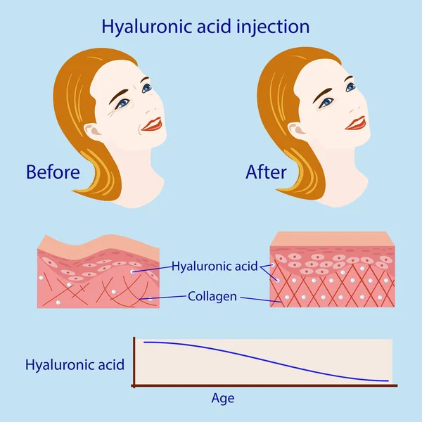 Inyección de ácido hialurónico, antes y después, ilustración vectorial, diagrama — Archivo Imágenes Vectoriales