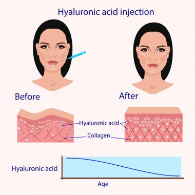hyaluronik asit enjeksiyonu, daha önce ve etkiler, vektör çizim, diyagram