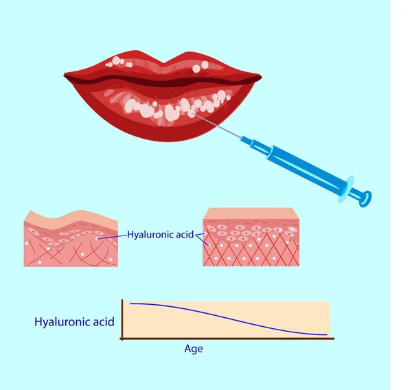 Hyaluronik asit enjeksiyonu, dudakları yordamı vektör çizim, diyagramı — Stok Vektör