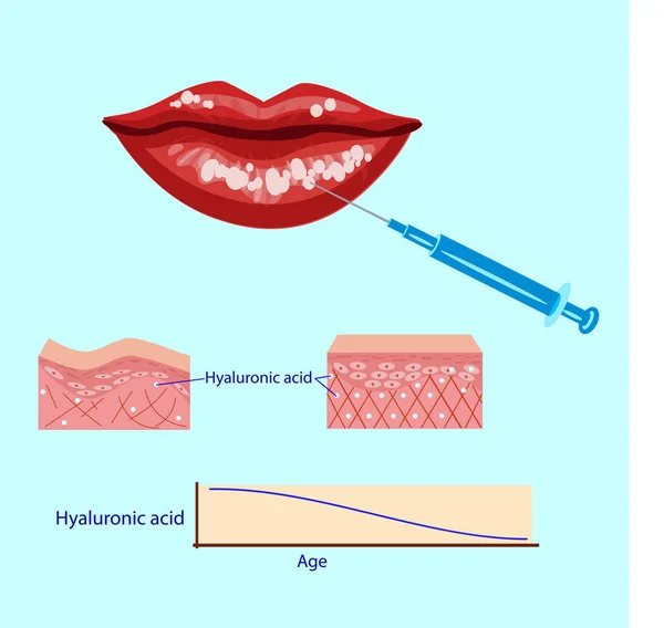 Inyección de ácido hialurónico, ilustración de vectores de procedimiento de labios, diagrama — Archivo Imágenes Vectoriales