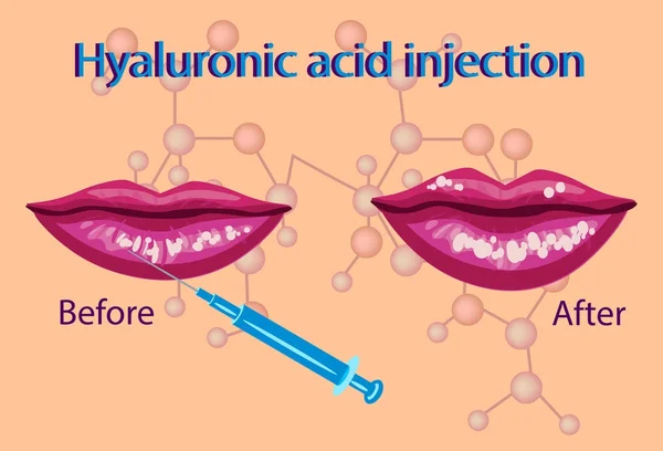 Hyaluronik asit enjeksiyonu, dudakları yordamı vektör çizim, — Stok Vektör