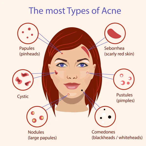 Diverso tipo di acne. Illustrazione vettoriale con problemi alla pelle . — Vettoriale Stock