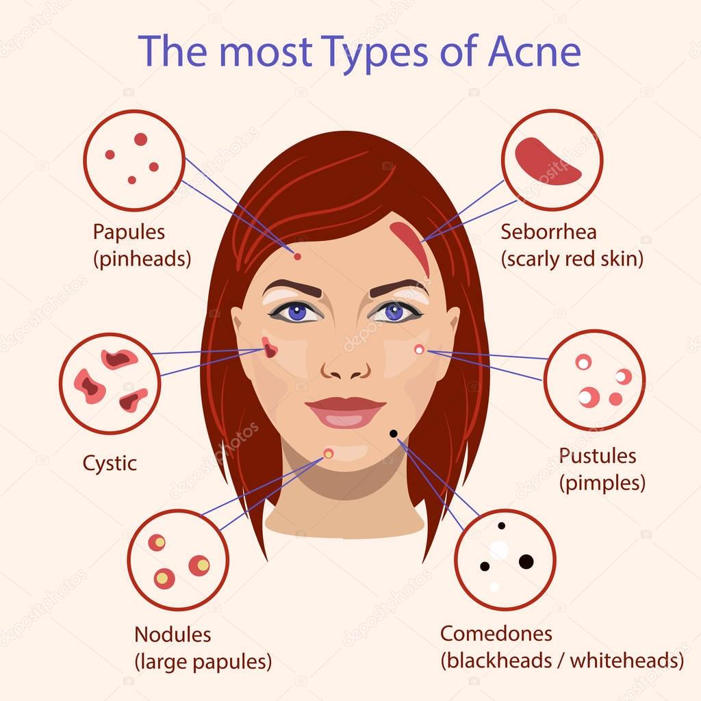 Different type of acne. Vector Illustration with skin problems.