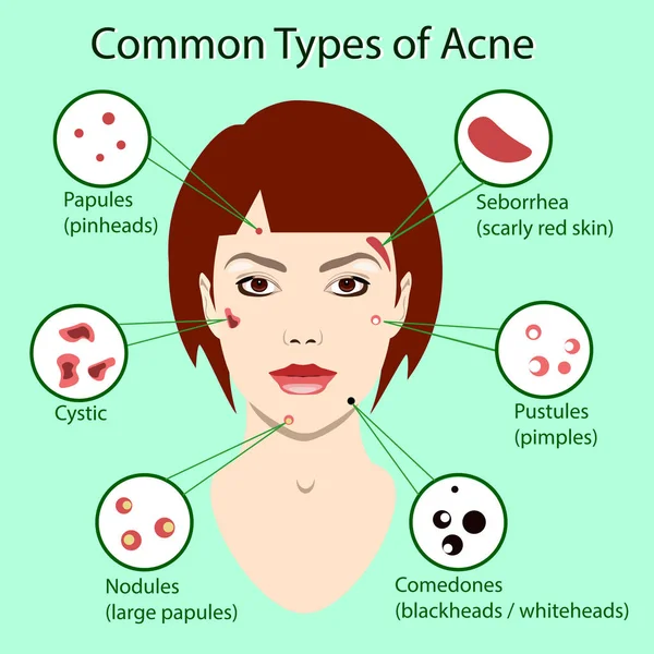 Diverso tipo di acne. Illustrazione vettoriale con problemi alla pelle. donna faccia isolata — Vettoriale Stock