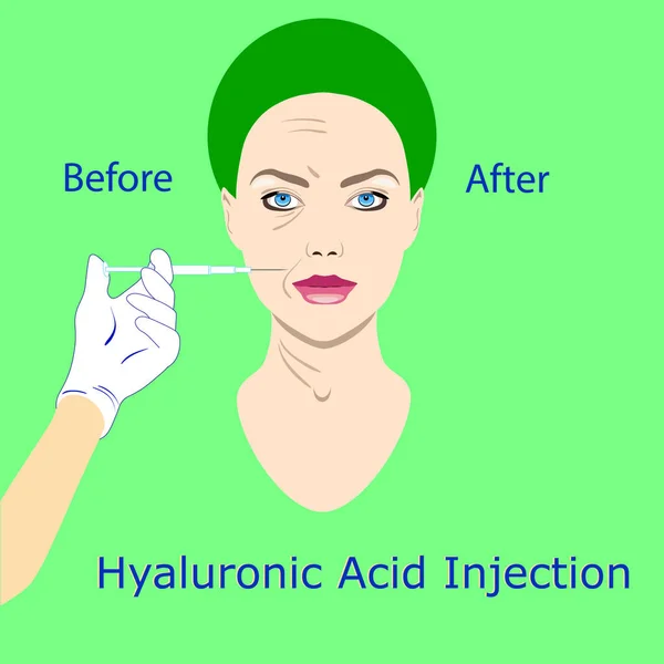 Hyaluronsyra injektion, innan och påverka, vektor illustration, — Stock vektor