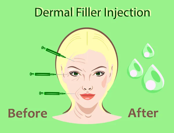 Cosmetische chirurgie vectorillustratie. Vuller injectie. vrouw gezicht rimpel behandeling. — Stockvector