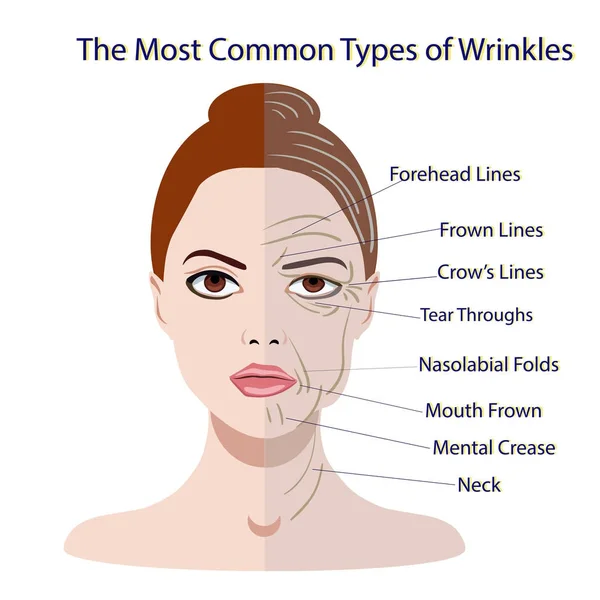 Common Types of Facial Wrinkles. cosmetic surgery. woman facial treatment — Stock Vector