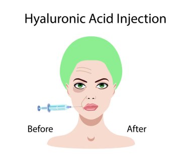 hyaluronik asit enjeksiyonu, daha önce ve etkiler, vektör çizim