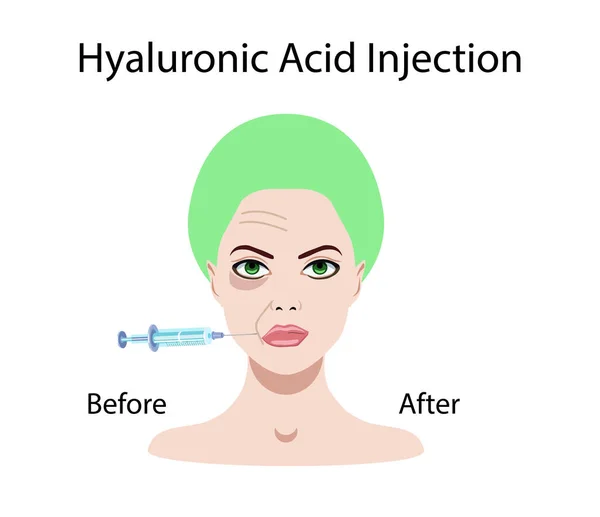 Hyaluronsyra injektion, innan och påverka, vektor illustration — Stock vektor