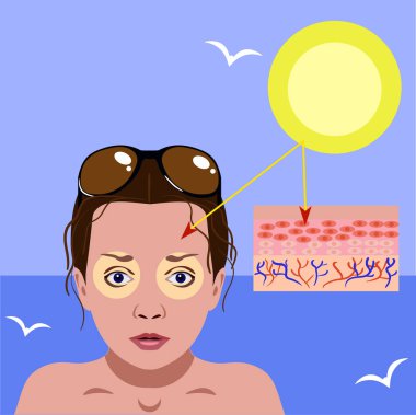 kadın yüz ve boyun deri üzerinde kızarıklık. Ultraviyole vektör Illustration tehlike hakkında. Deniz arka plan üzerinde