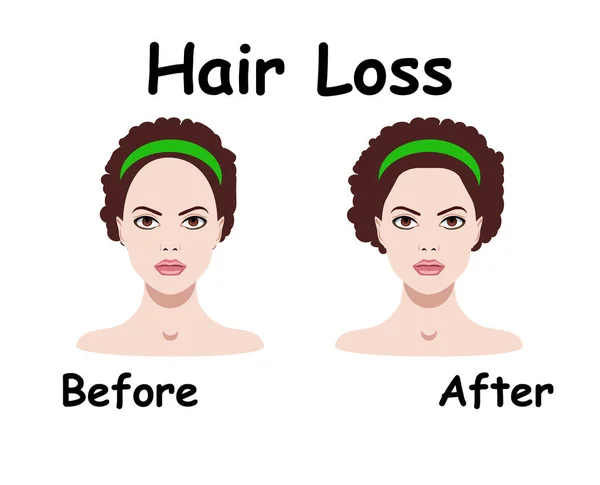 Ilustração vetorial para o tratamento da perda de cabelo —  Vetores de Stock