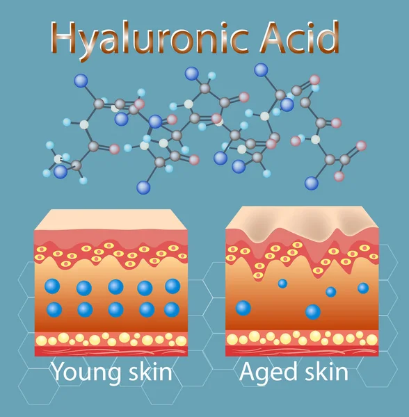 Векторная иллюстрация с процессом старения кожи из-за недостатка гиалуроновой кислоты — стоковый вектор