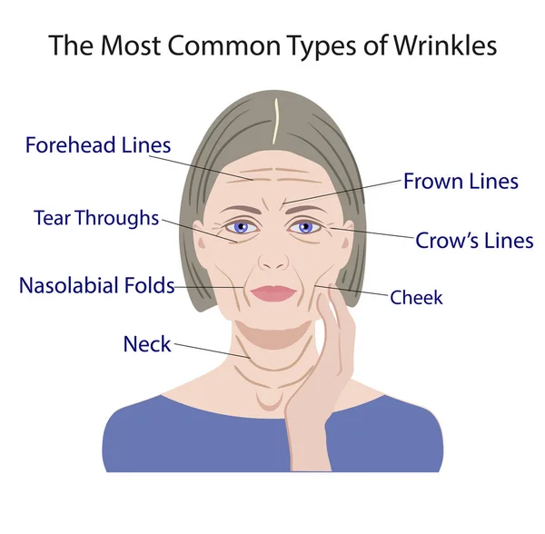 Common Types of Facial Wrinkles. cosmetic surgery. woman facial treatment — Stock Vector