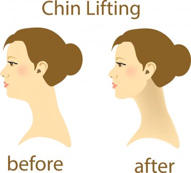 Illustration of a woman with a double chin and a normal chin surgery clipart