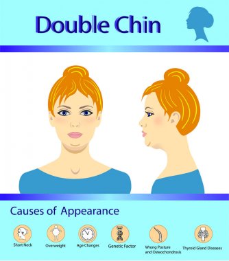 Causes of double chin, vector illustration diagram clipart