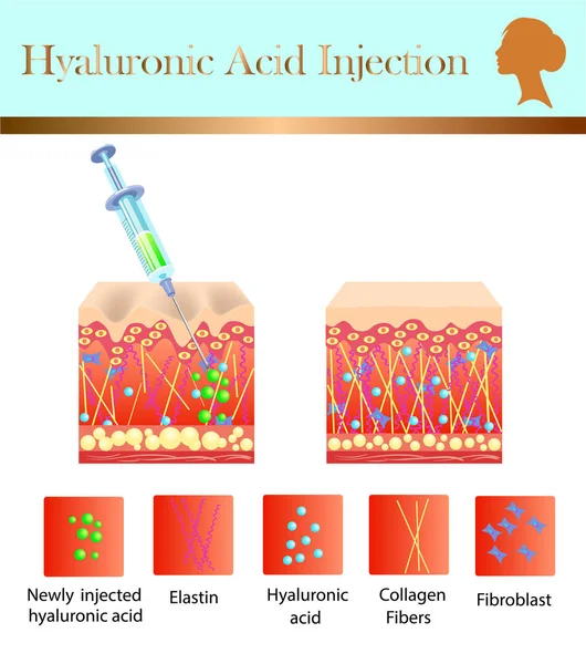 Hyaluronsyra injektion, innan och påverka, vektor illustration — Stock vektor