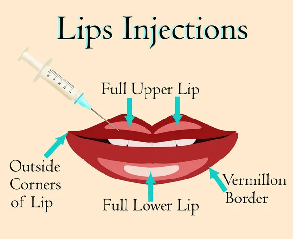 Dudak enjeksiyon vektör çizim — Stok Vektör