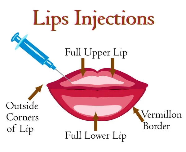 Dudak enjeksiyon vektör çizim — Stok Vektör