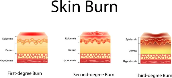 Hautverbrennungen. drei Grad Verbrennungen. Art der Verletzung der Haut, Vektorillustration — Stockvektor