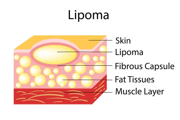 Lipoma a zsírszövet daganatok található a bőr alatti szövetek. — Stock Vector