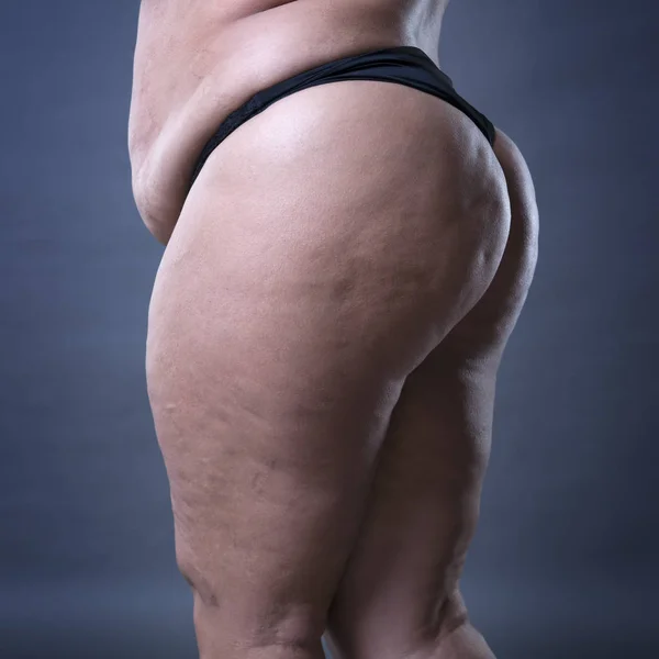 Selülit, yağlı kalça ve kalça ile şişman kadın bedeni — Stok fotoğraf