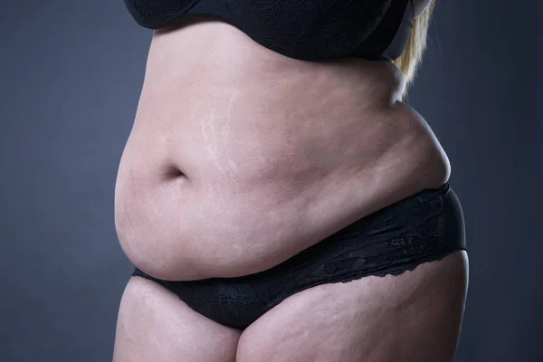 Vientre femenino gordo, estrías en primer plano — Foto de Stock