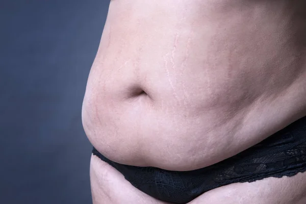 Fat female belly, stretch marks closeup — Stock Photo, Image