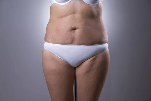 妊娠纹松弛女人的肚子 — 图库照片