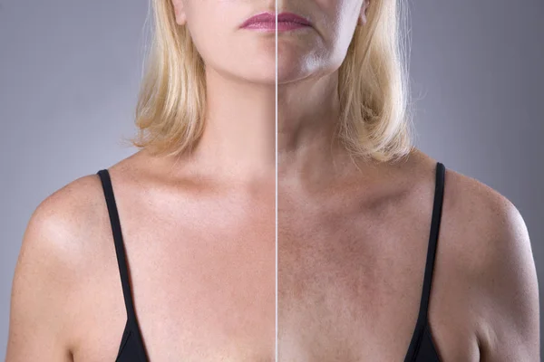 Žena omlazení kůže, před po anti stárnutí koncept, ošetření vrásek, facelift a plastické chirurgie — Stock fotografie