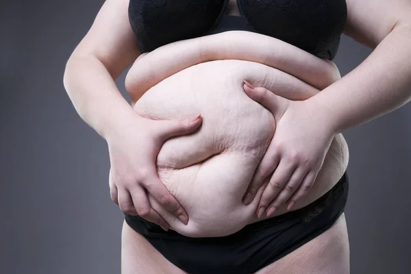 Fat female belly, overweight body, woman with stretch marks on abdomen — Stock Photo, Image