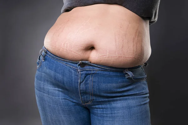 Γυναίκα με λίπος κοιλιά στο μπλε τζιν, το υπερβολικό βάρος θηλυκό στομάχι, ραγάδες στην κοιλιά closeup — Φωτογραφία Αρχείου