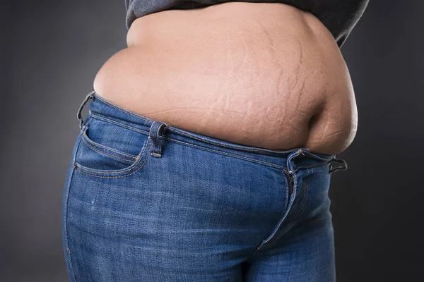 Mujer con abdomen gordo en jeans azules, estómago femenino con sobrepeso, estrías en el primer plano del vientre —  Fotos de Stock