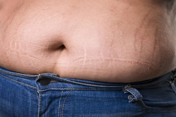 Woman with fat abdomen in blue jeans, overweight female stomach, stretch marks on belly closeup