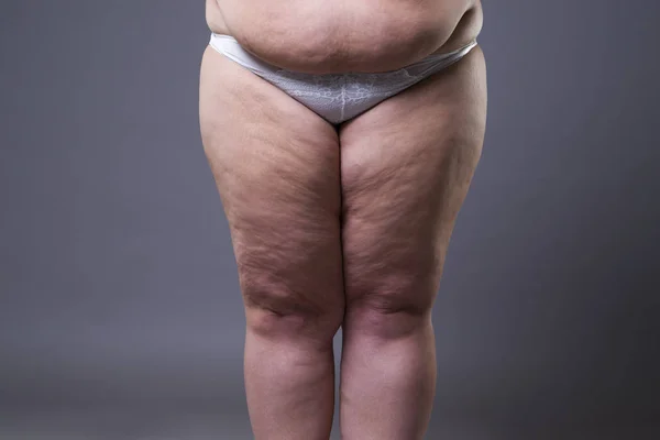 Overweight woman with fat legs, obesity female body