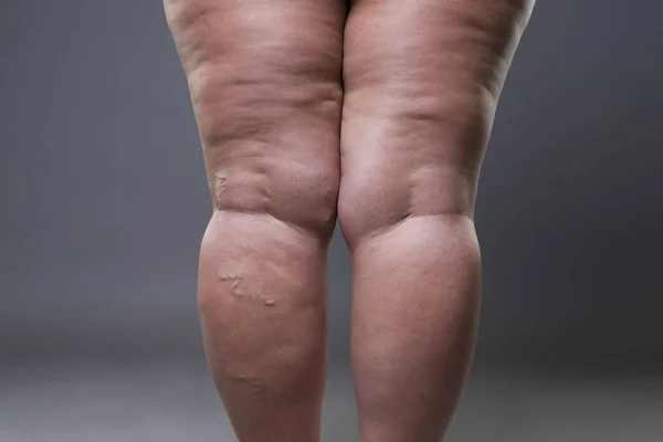 Varices gros plan, grosses jambes de cellulite féminine — Photo