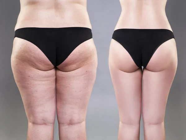 Donna sovrappeso con gambe grasse e glutei, prima dopo il concetto, obesità corpo femminile, vista posteriore — Foto Stock