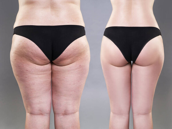 Overweight woman with fat legs and buttocks, before after concept, obesity female body, rear view