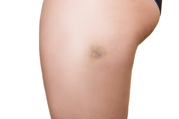 Modřina na ženské noze, izolované na bílém pozadí — Stock fotografie