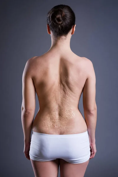 Mulher com uma grande cicatriz depois de queimar nas costas — Fotografia de Stock