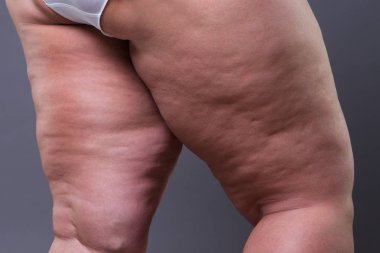 Selülit, kilolu kalça ve bacakları ile şişman kadın bedeni