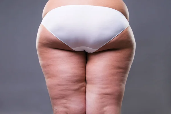 Cuerpo femenino graso con celulitis, caderas con sobrepeso y nalgas — Foto de Stock